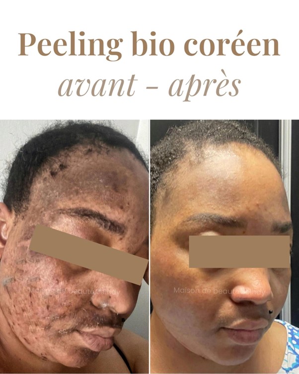 peeling bio paris